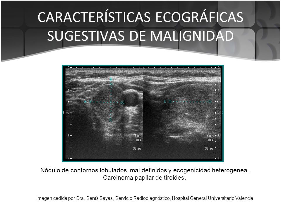 Imagenes ecograficas de tiroides
